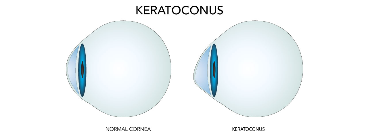 keratoconus